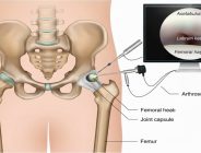 Kalça Ağrılarına Modern Çözüm: Artroskopik Cerrahi Rehberi