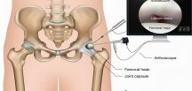 Kalça Ağrılarına Modern Çözüm: Artroskopik Cerrahi Rehberi