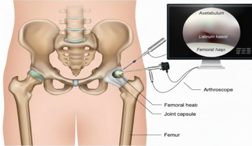 Kalça Ağrılarına Modern Çözüm: Artroskopik Cerrahi Rehberi